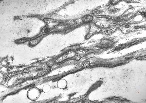 M,15y. | neurinoma n. optici M,15y. | neurinoma n. optici